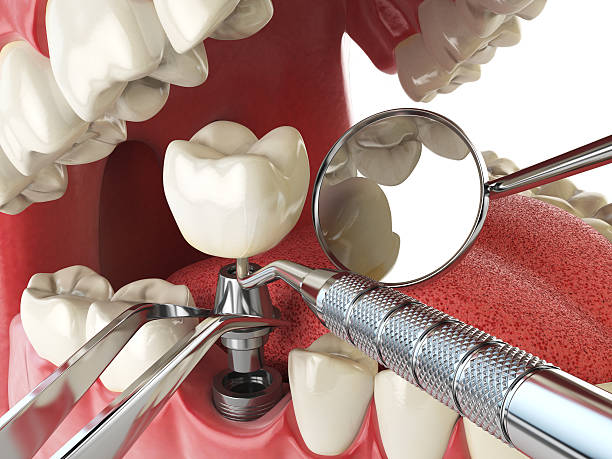 Best Emergency Tooth Extraction in Vance, AL